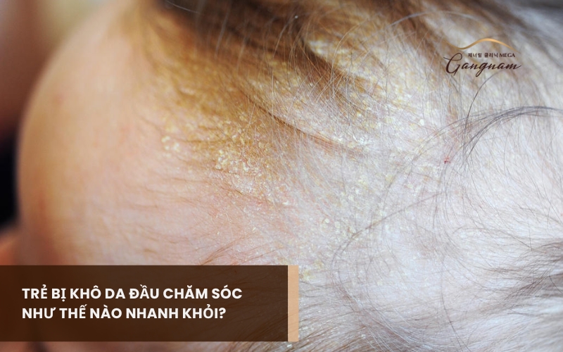 Giải đáp nguyên nhân trẻ bị khô da đầu, các giai đoạn phát triển và cách chăm sóc tại nhà 