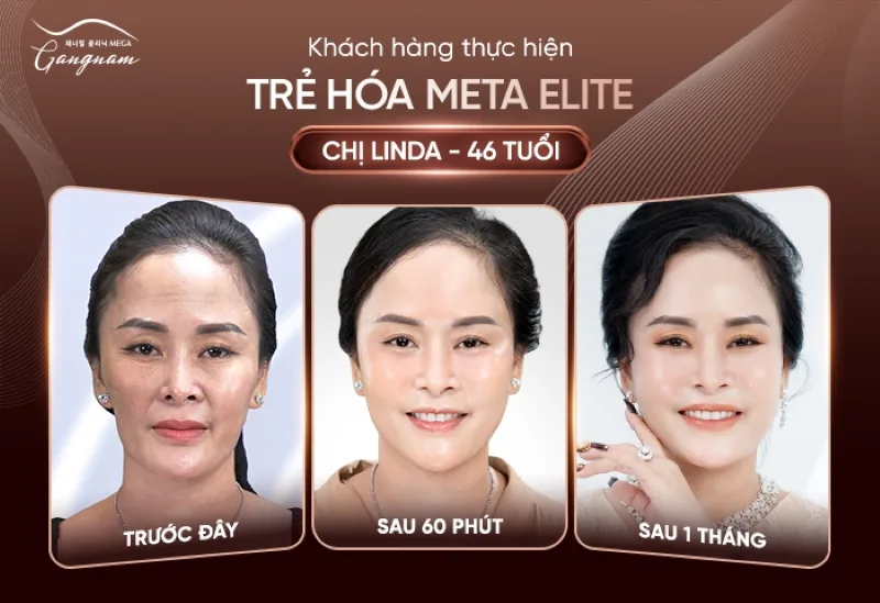 Sự thay đổi của khách hàng sau khi áp dụng liệu pháp trẻ hóa Meta Elite 