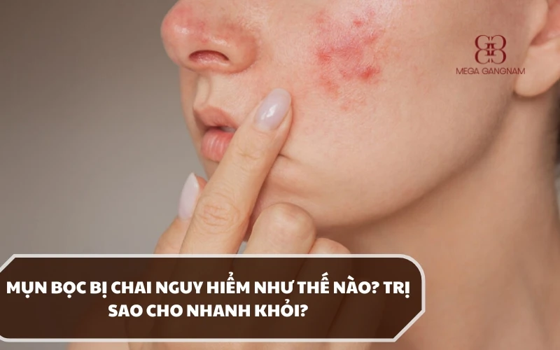 Nhận biết mụn bọc bị chai và hướng điều trị thích hợp đảm bảo an toàn và nhanh khỏi 