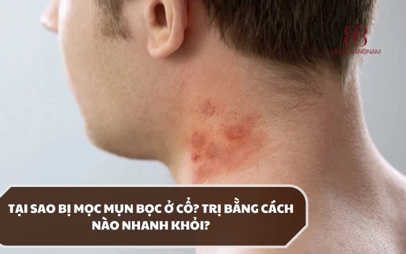 Các dấu hiệu phân biệt mụn bọc ở cổ và các loại mụn khác. Hướng dẫn chi tiết cách điều trị!