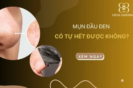 Mụn đầu đen có tự hết được không?