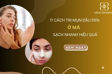 11 cách trị mụn đầu đen ở má sạch nhanh hiệu quả