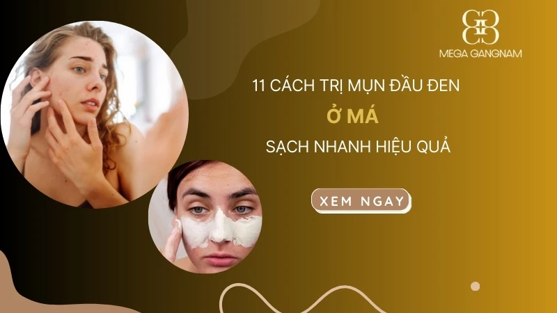 11 cách trị mụn đầu đen ở má sạch nhanh hiệu quả 