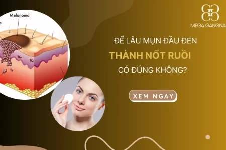 Để lâu mụn đầu đen thành nốt ruồi có đúng không?