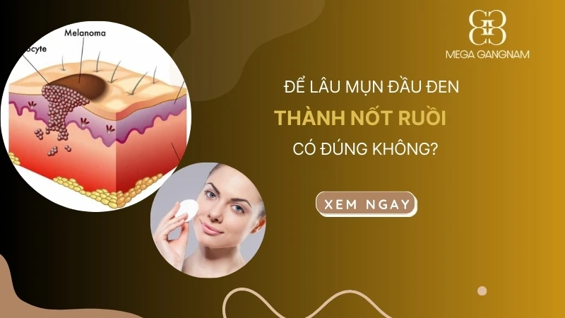 Để lâu mụn đầu đen thành nốt ruồi có đúng không?