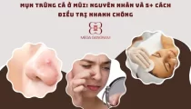 Mụn trứng cá ở mũi: Nguyên nhân và 5+ cách điều trị nhanh chóng