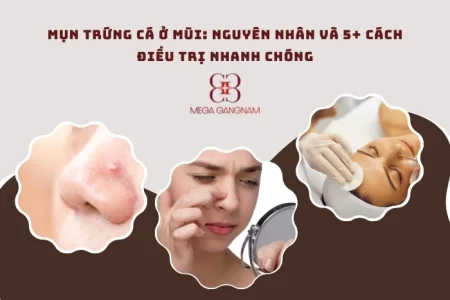 Mụn trứng cá ở mũi: Nguyên nhân và 5+ cách điều trị nhanh chóng