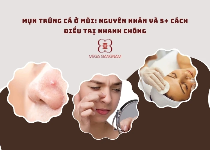 Mụn trứng cá ở mũi: Nguyên nhân và 5+ cách điều trị nhanh chóng