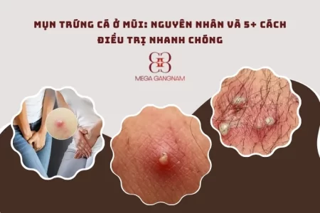 Mụn trứng cá ở vùng kín là gì?