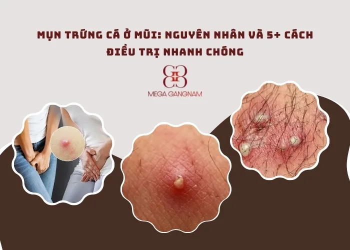 Mụn trứng cá ở vùng kín là gì?