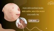 Mụn viêm không nhân: Đặc điểm, nguyên nhân và cách điều trị