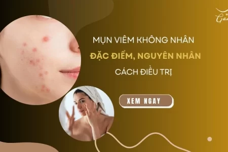 Mụn viêm không nhân: Đặc điểm, nguyên nhân và cách điều trị