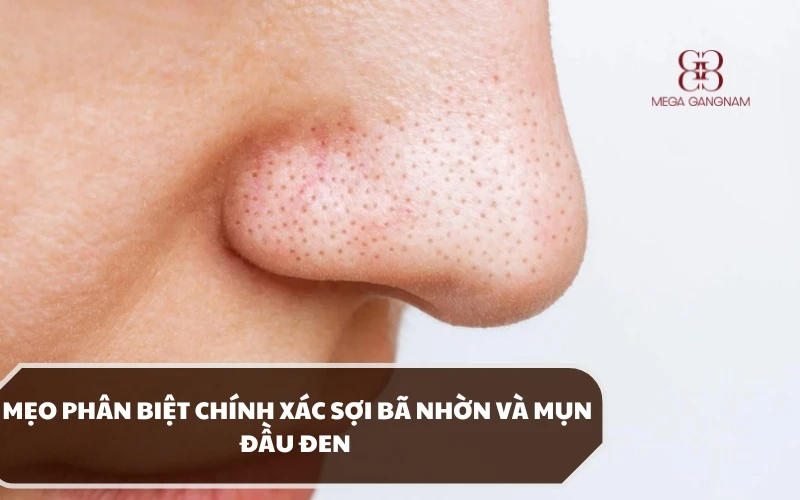 Giải đáp chi tiết điểm giống - khác nhau của sợi bã nhờn và mụn đầu đen 