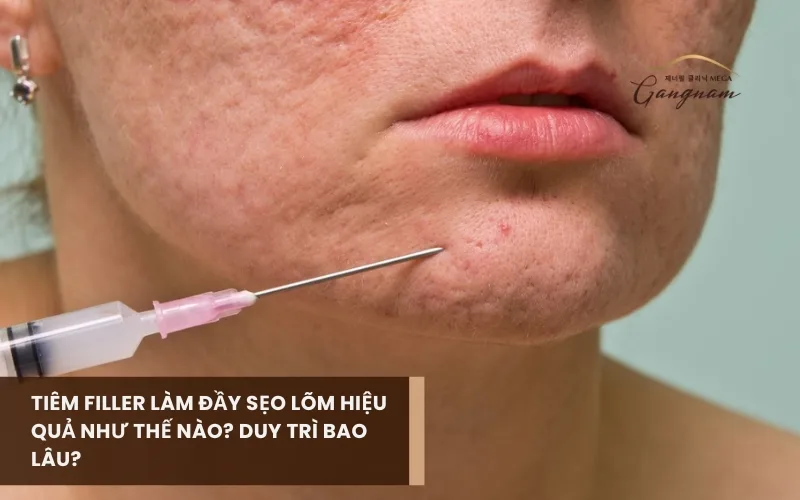 Tiêm filler làm đầy sẹo lõm hiệu quả như thế nào? Đối tượng và mức độ sẹo phù hợp