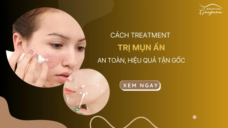 Cách treatment trị mụn ẩn an toàn, hiệu quả tận gốc