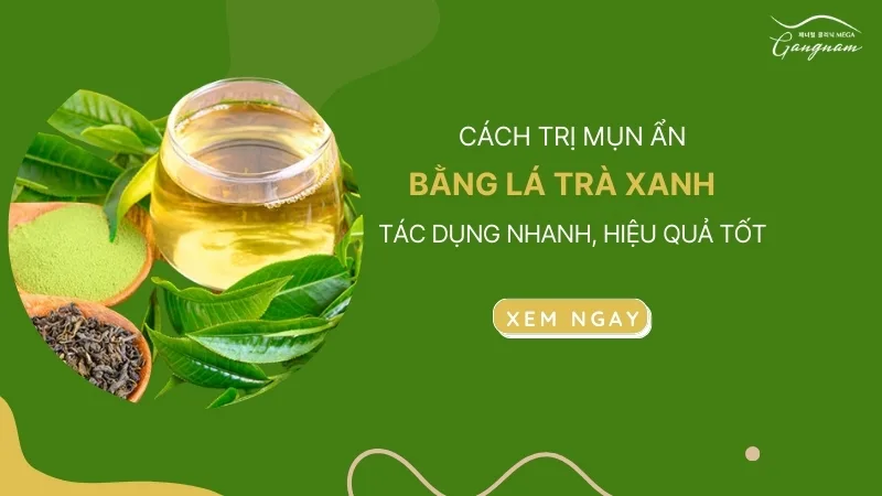 Cách trị mụn ẩn bằng lá trà xanh tác dụng nhanh, hiệu quả tốt