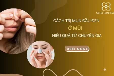 Cách trị mụn đầu đen ở mũi hiệu quả từ chuyên gia