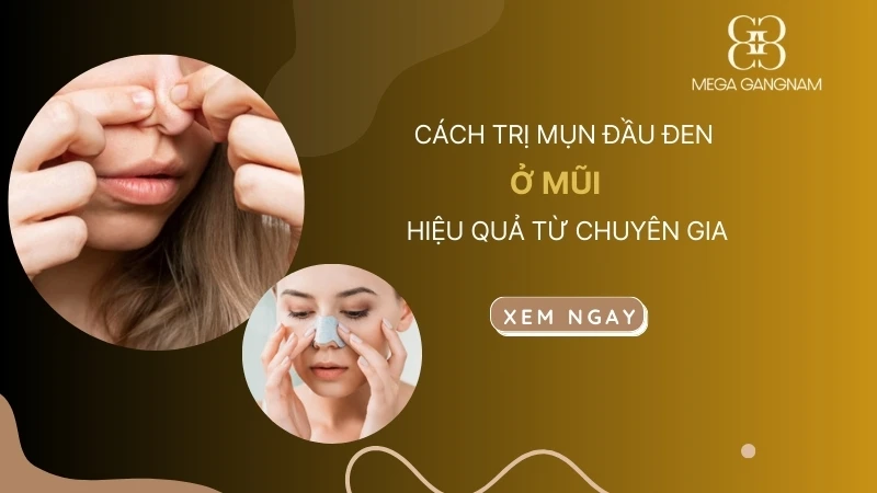 Cách trị mụn đầu đen ở mũi hiệu quả từ chuyên gia