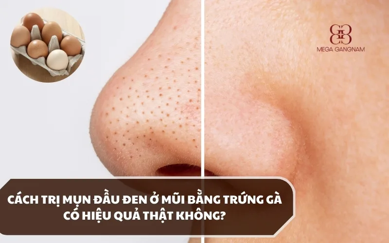 Cách trị mụn đầu đen ở mũi bằng trứng gà như thế nào? Hiệu quả có tốt không? 