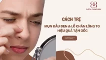 Cách trị mụn đầu đen và lỗ chân lông to hiệu quả tận gốc