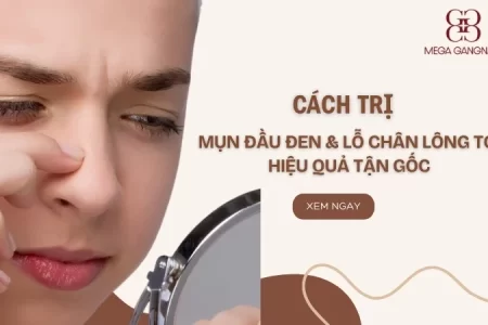 Cách trị mụn đầu đen và lỗ chân lông to hiệu quả tận gốc