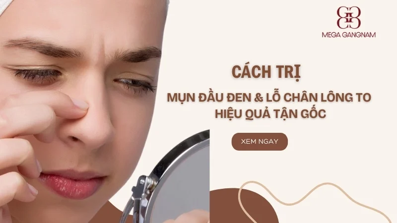 Cách trị mụn đầu đen và lỗ chân lông to hiệu quả tận gốc