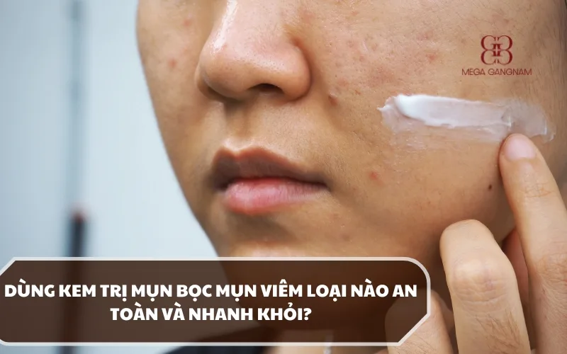 Dùng kem trị mụn bọc mụn viêm loại nào an toàn và nên sử dụng cho da mặt? 