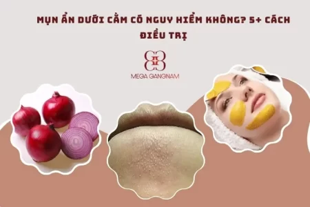 Mụn ẩn dưới cằm có nguy hiểm không?