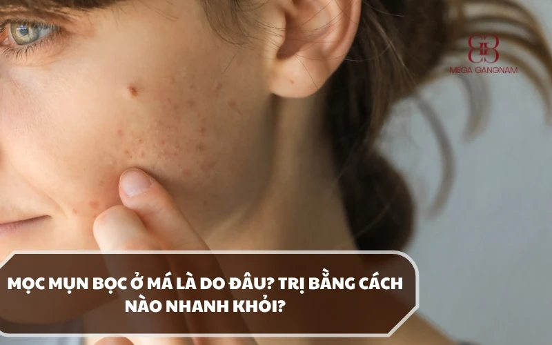 Tổng hợp các nguyên nhân dẫn đến sự xuất hiện của mụn bọc ở má và cách điều trị