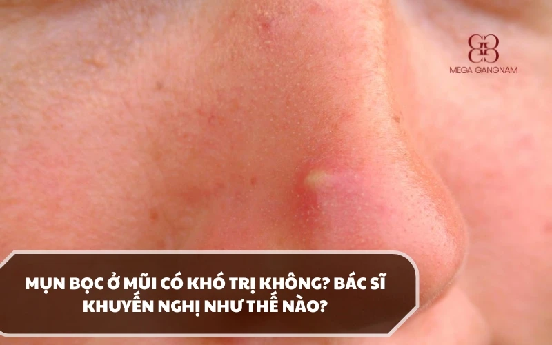 Nguyên nhân gây mụn bọc ở mũi là gì? Điều trị bằng phương pháp nào hiệu quả tốt? 