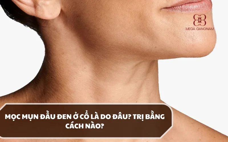 Giải đáp chi tiết mụn đầu đen ở cổ nguyên nhân là do đâu? Trị cách nào nhanh khỏi? 