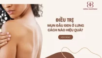 Trị mụn đầu đen ở lưng cách nào hiệu quả?