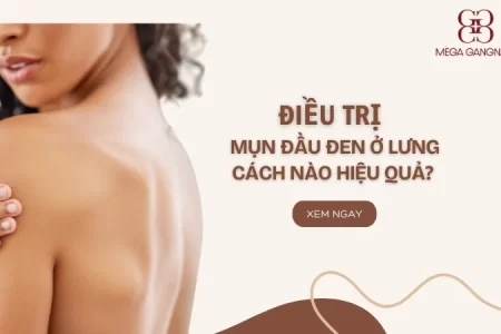 Trị mụn đầu đen ở lưng cách nào hiệu quả?