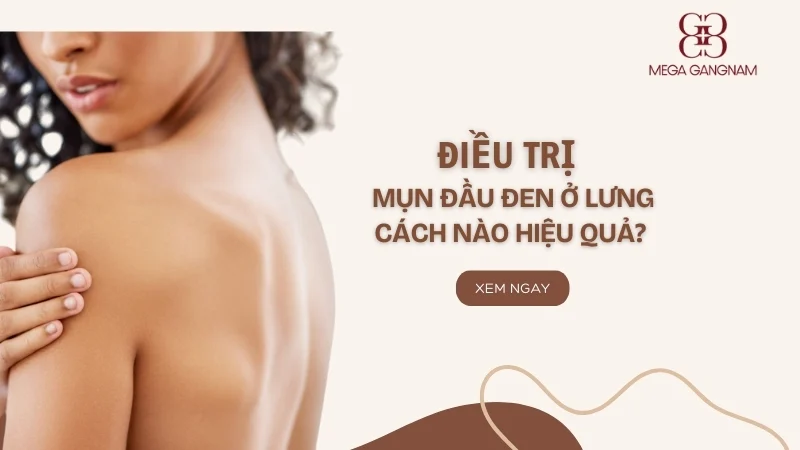 Trị mụn đầu đen ở lưng cách nào hiệu quả?