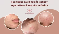 Mụn trứng cá có tự hết không?