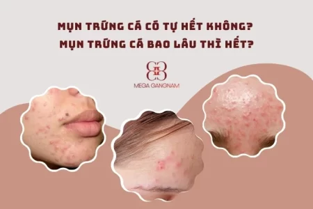 Mụn trứng cá có tự hết không?