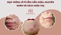 Mụn trứng cá ở cằm: Dấu hiệu, nguyên nhân và cách chữa trị