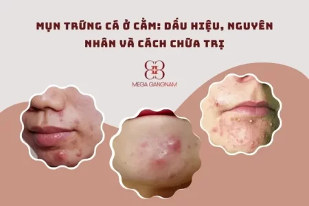 Mụn trứng cá ở cằm: Dấu hiệu, nguyên nhân và cách chữa trị