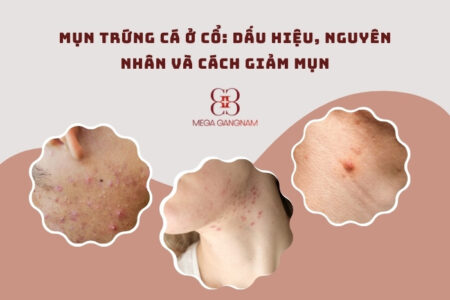 Mụn trứng cá ở cổ: Dấu hiệu, nguyên nhân và cách giảm mụn