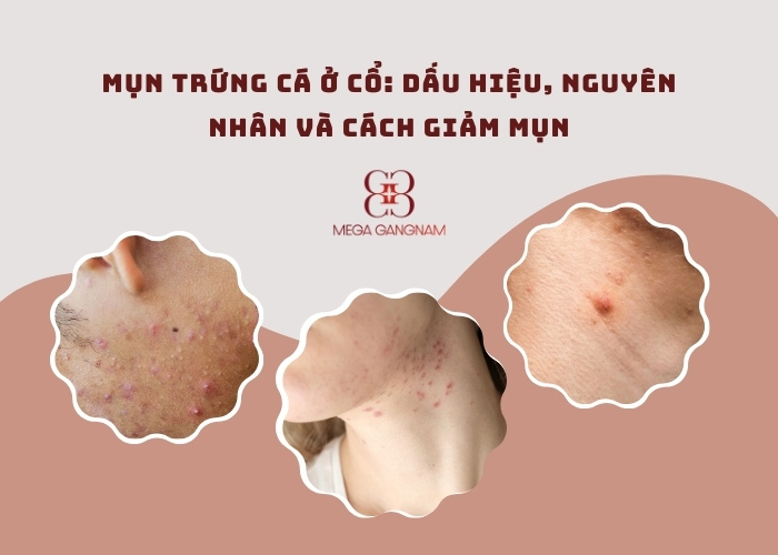 Mụn trứng cá ở cổ: Dấu hiệu, nguyên nhân và cách giảm mụn