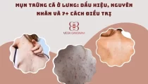 Mụn trứng cá ở lưng: Dấu hiệu, nguyên nhân và 7+ cách điều trị