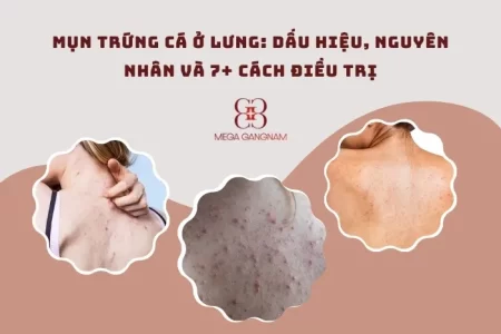 Mụn trứng cá ở lưng: Dấu hiệu, nguyên nhân và 7+ cách điều trị