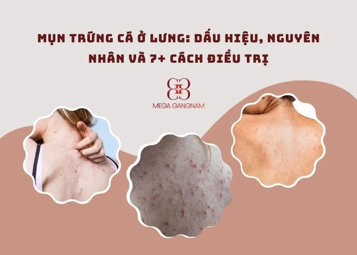 Mụn trứng cá ở lưng: Dấu hiệu, nguyên nhân và 7+ cách điều trị