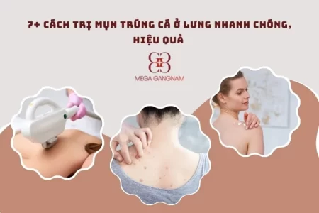 Cách trị mụn trứng cá ở lưng hiệu quả, an toàn