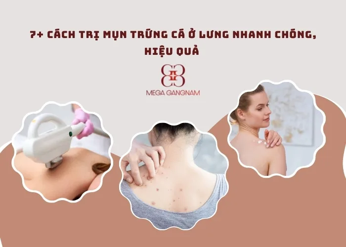 Cách trị mụn trứng cá ở lưng hiệu quả, an toàn