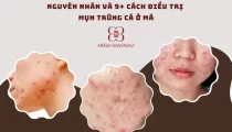 Nguyên nhân và 9+ cách điều trị mụn trứng cá ở má