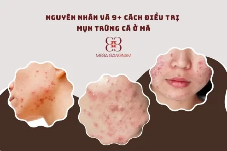 Nguyên nhân và 9+ cách điều trị mụn trứng cá ở má