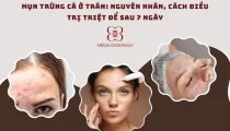 Mụn trứng cá ở trán là gì?