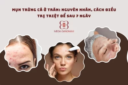 Mụn trứng cá ở trán là gì?