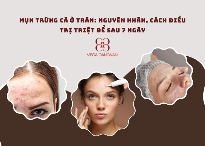 Mụn trứng cá ở trán là gì?